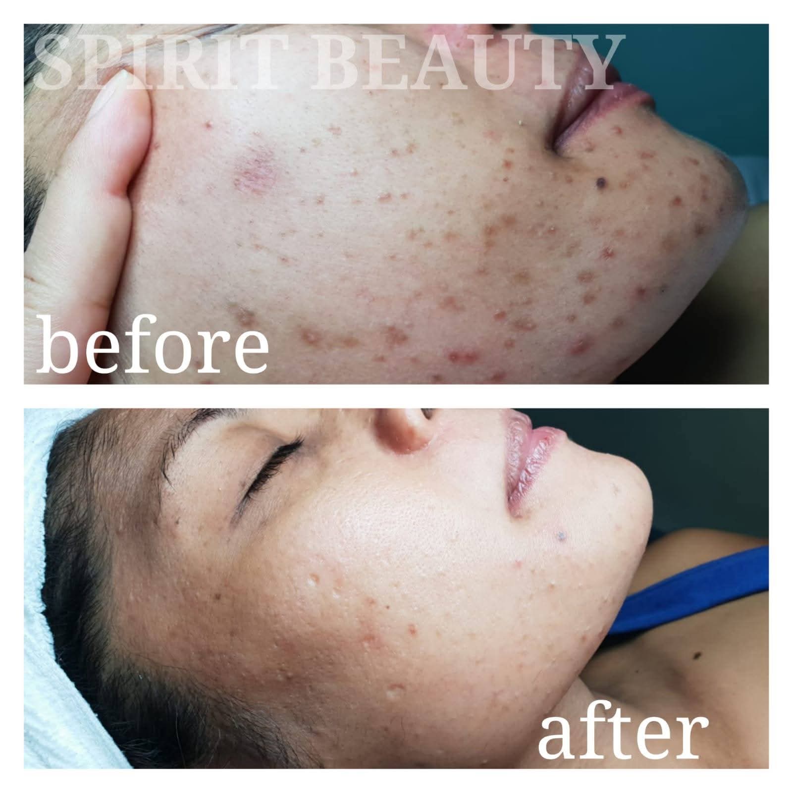 Facial treatment before and after result