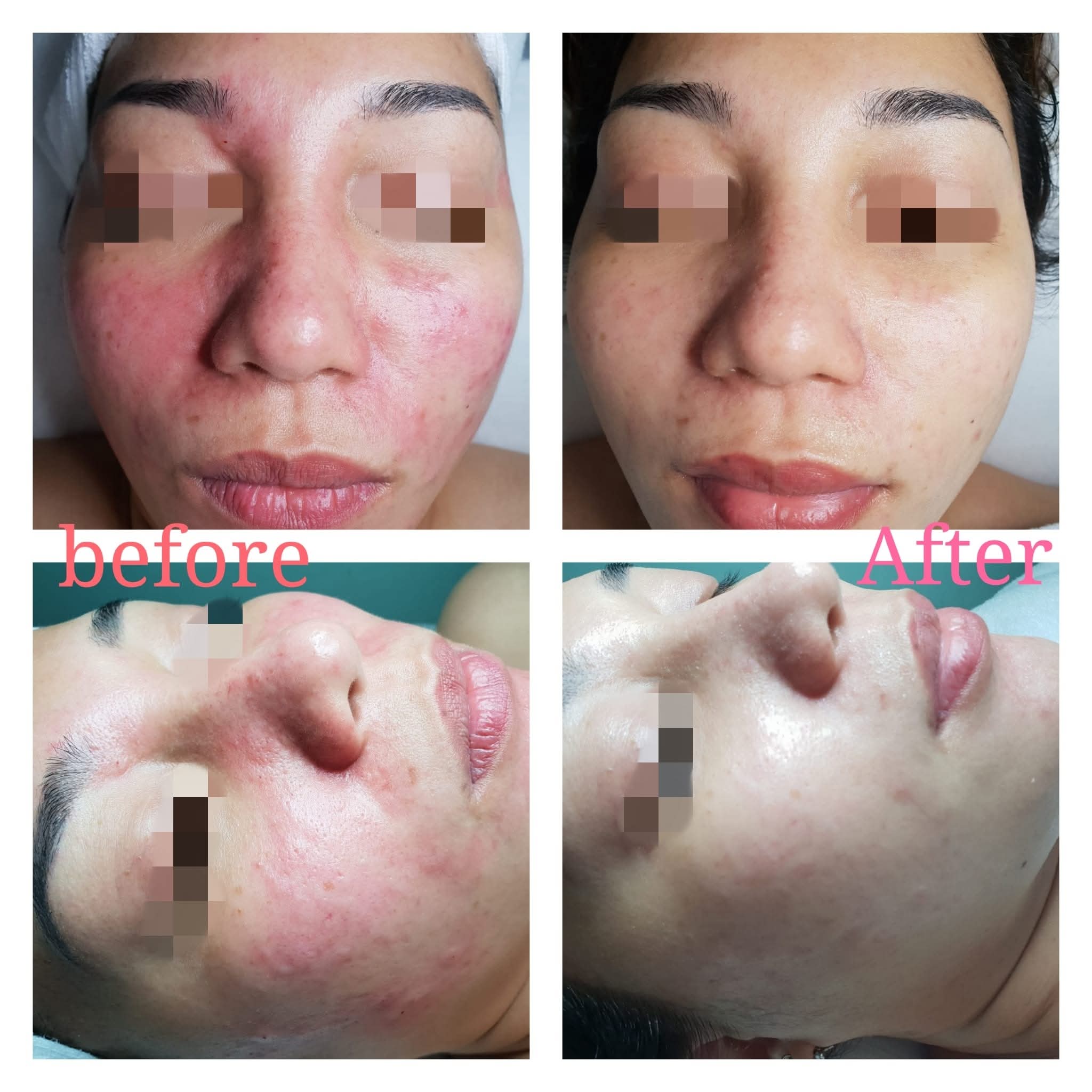 Facial treatment before and after result