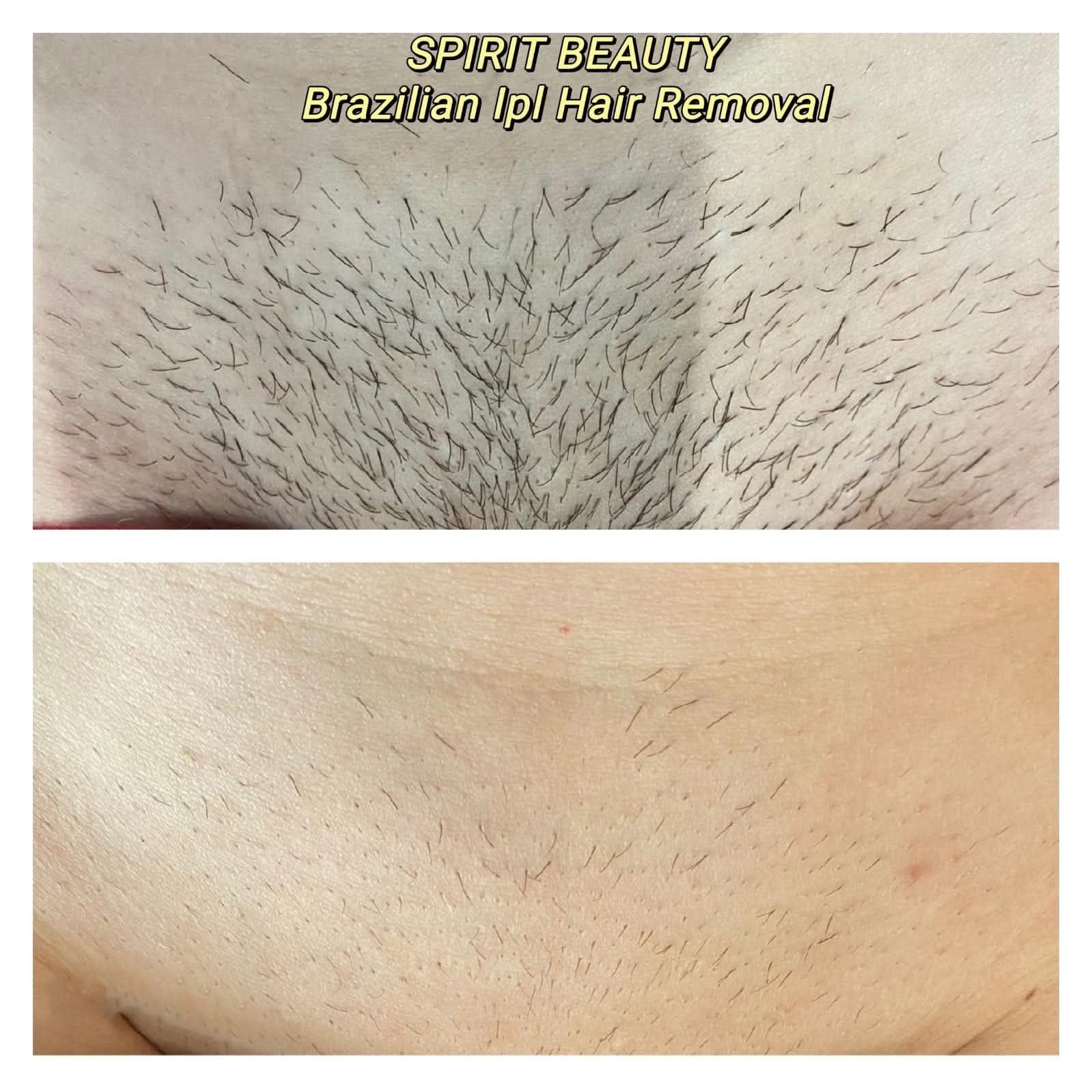 Brazilian IPL before and after result
